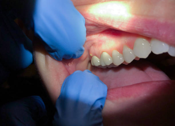 Best Emergency Tooth Extraction in Copperas Cove, TX